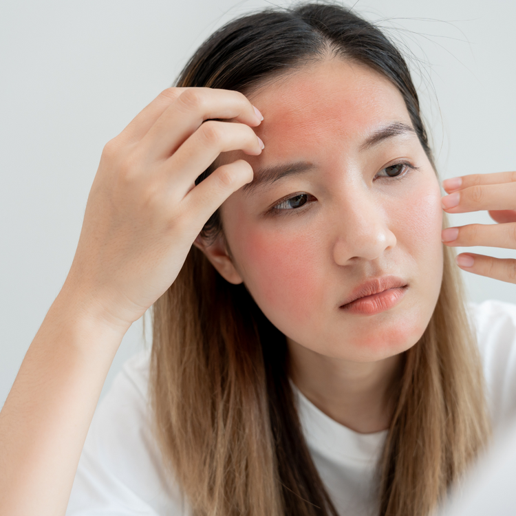 Skin Concern: Sunburn