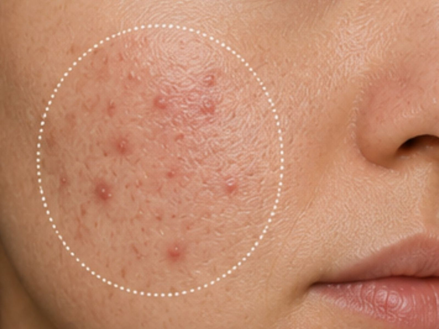 Acne-prone Skin