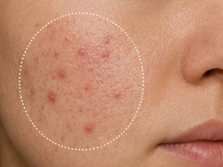 Acne-prone Skin