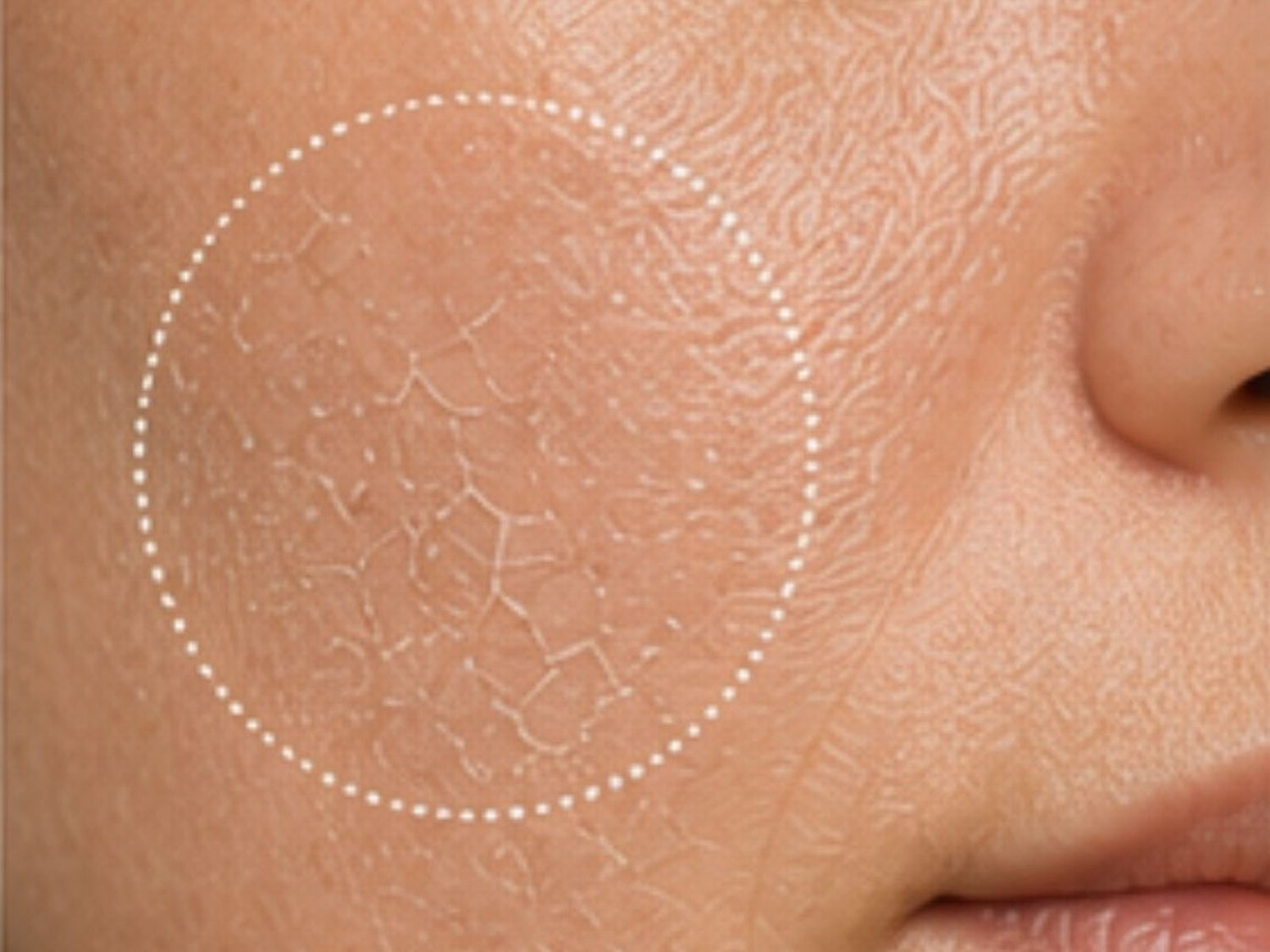 Dry Skin Type
