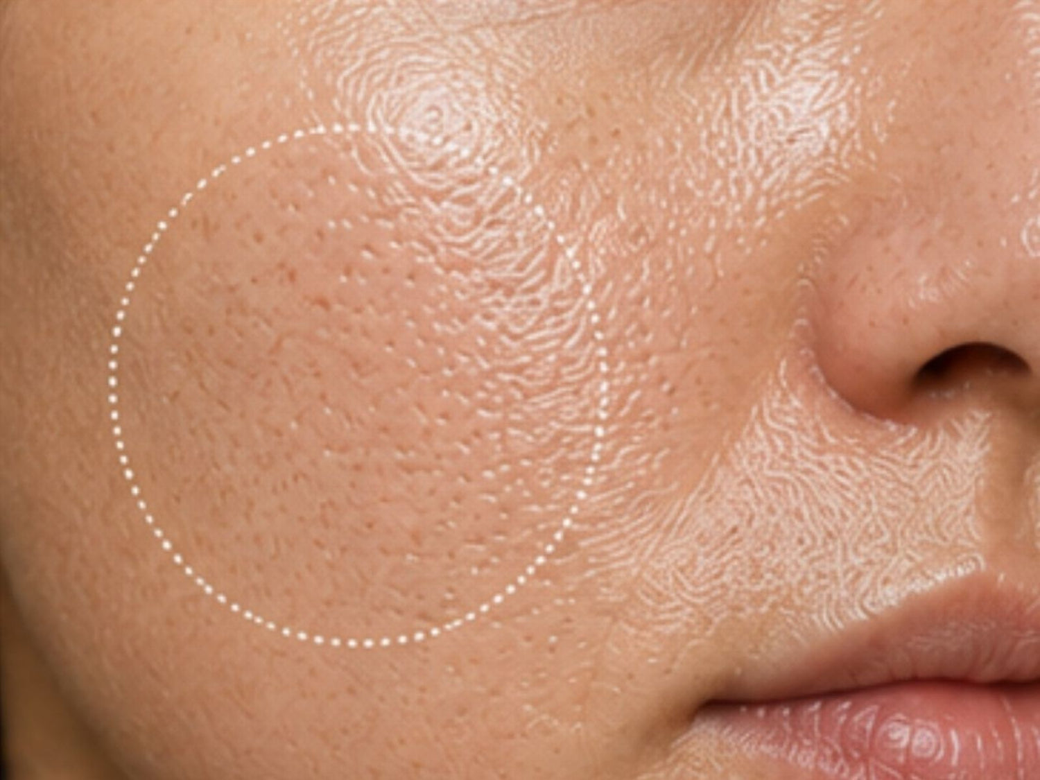Enlarged Pores