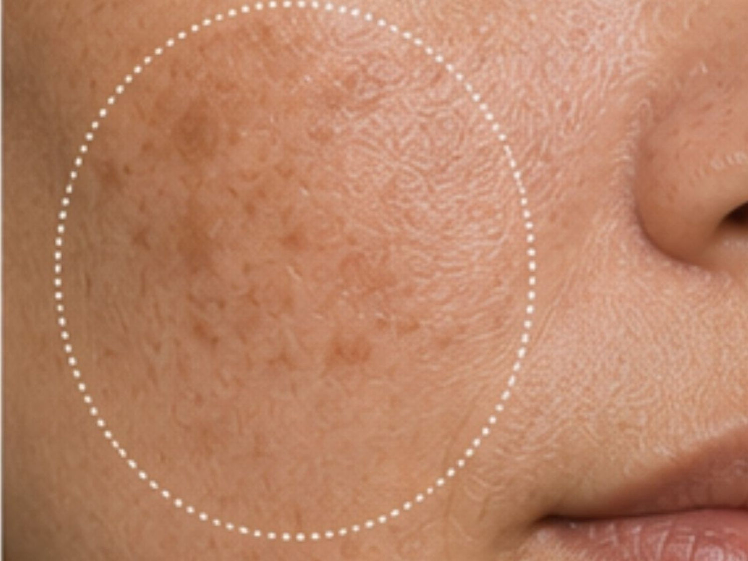 Hyperpigmentation